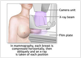 Breast Cancer Diagnosing