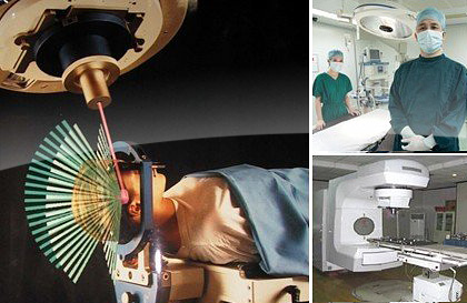 Pisau Photon : 3D Radioterapi Stereotactic – Sinar multipel, dari banyak sisi, dan mengikuti bentuk tumor 