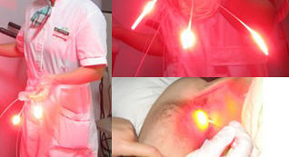 รักษามะเร็งด้วยเลเซอร์（Photodynamic Therapy，PDT）——“ฉายเลเซอร์”ต่อต้านโรคมะเร็ง