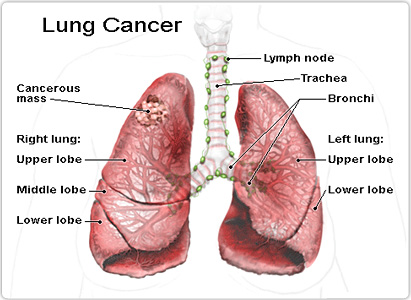 Lung Cancer Symptoms