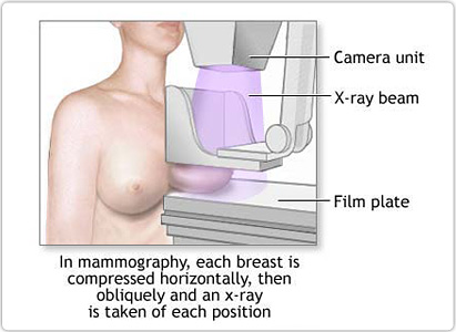 Needle biopsy underused in breast caNcer diagnosis, negatively impacting diagnosis and care