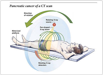 MU Study Finds More Accurate Method to Diagnose Pancreatic Cancer