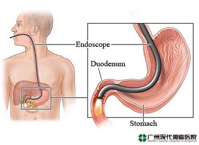 mendiagnosa kanker lambung