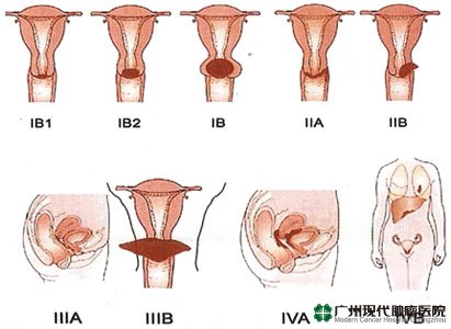 Kanker Vagina 2