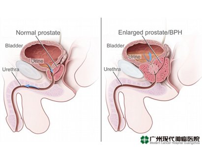 Kanker Prostat