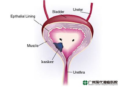Kanker Kandung Kemih 
