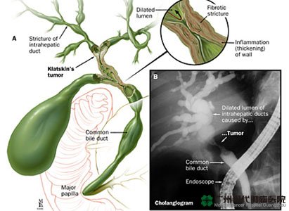 Cholangiocarcinoma