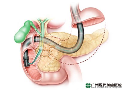 Cholangiocarcinoma 3