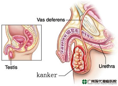 Gejala Dan Penyebab Timbulnya Kanker Testis