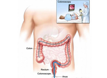 มะเร็งลำไส้ใหญ่,การวินิฉัยโรคมะเร็งลำไส้ใหญ่,โรงพยาบาลมะเร็งสมัยใหม่กว่างโจว