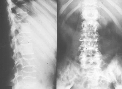 Diagnosis Multiple Myeloma