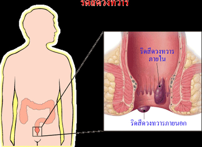 มะเร็งทวารหนัก,โรงพยาบาลมะเร็งสมัยใหม่กว่างโจว