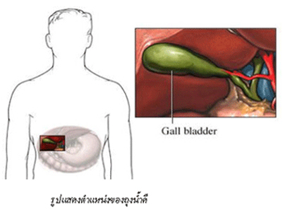 มะเร็งถุงน้ำดี,อาการของมะเร็งถุงน้ำดี,การวินิจฉัยโรคมะเร็งถุงน้ำดี,การดูแลผู้ป่วยโรคมะเร็งถุงน้ำดี,โรงพยาบาลมะเร็งสมัยใหม่กว่างโจว