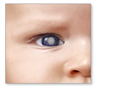 อาการโรคมะเร็งตา