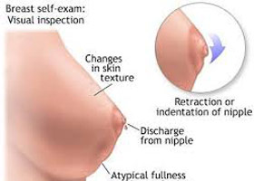 Be Aware of Common Symptoms of Breast Cancer