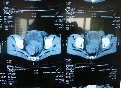 CT Image Before the Treatment (on August 31,2014)