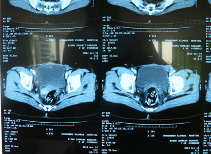 CT Image After  the Treatment (on October 19,2014)
