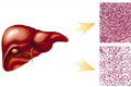Pengobatan Sirosis hati dengan Stem Sel menjadi pilihan utama