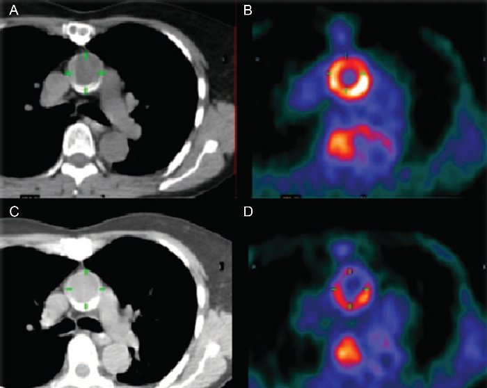 PET/CT