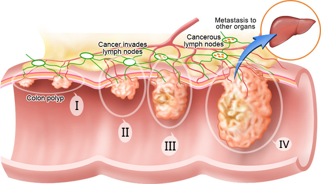 Stages of Colorectal Cancer