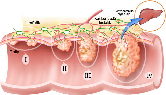 Stadium Kanker Usus