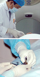 Phương pháp cấy hạt phóng xạ