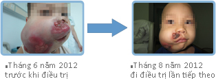 Tháng 8 năm 2012 lần điều trị 
thứ hai