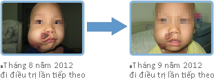 Tháng 9 năm 2012 lần điều trị 
thứ ba