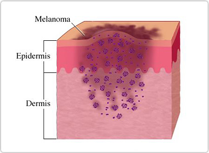 Skin Cancer Symptoms