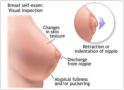 Breast Cancer Symptoms