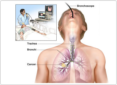 Lung Cancer Diagnosis