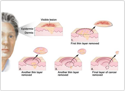 Skin Cancer Diagnosis