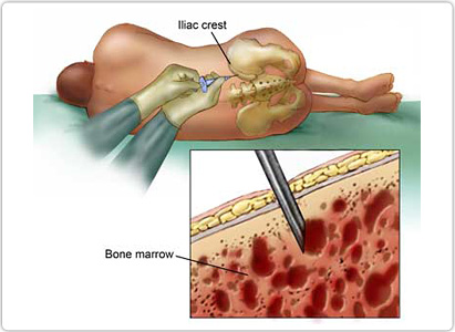 Leukemia Diagnosis