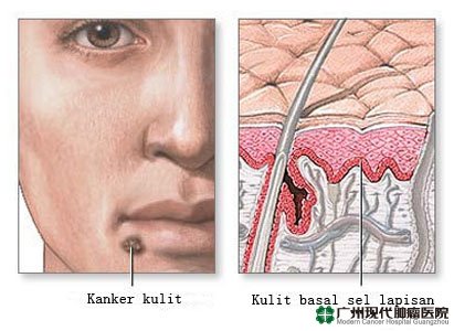 Kanker kulit
