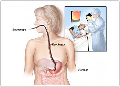 Stomach Cancer Diagnosis