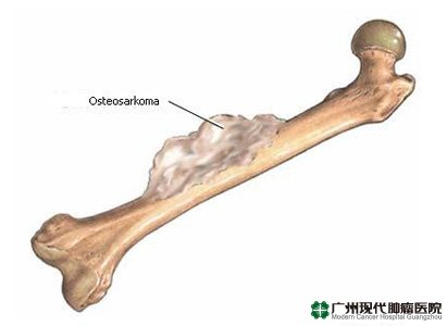 Gejala Osteosarcoma