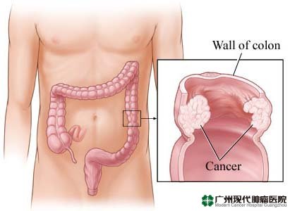 Gejala Kanker Usus Besar