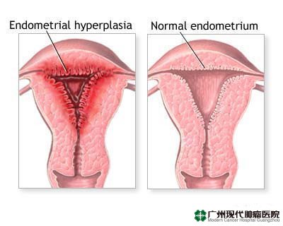 Kanker Lapisan Endometrium
