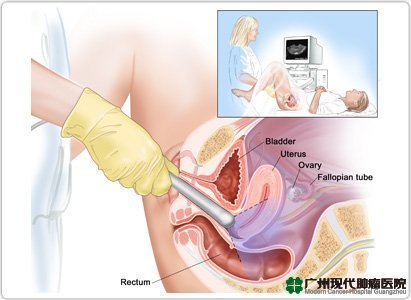 Kanker Lapisan Endometrium 2
