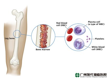 Multiple myeloma