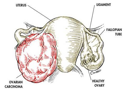 Ovarian Cancer Symptoms