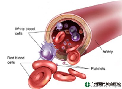 Gejala Leukemia