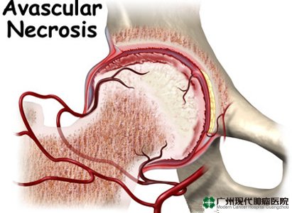 Avascular Nekrosis