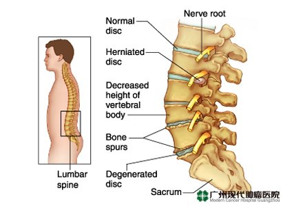 Herniasi Diskus Lumbal