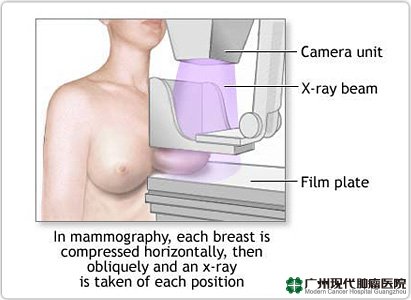 Diagnosis Kanker Payudara