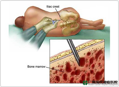 Diagnosa Gejala Leukaemia