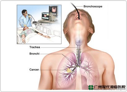 DIAGNOSA KANKER PARU PARU 