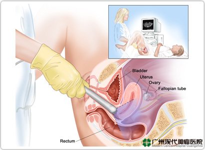 diagnosis kanker varium