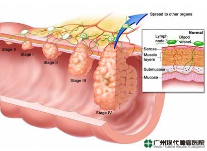 diagnosis kanker usus besar