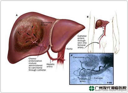 Diagnosis Kanker Hati